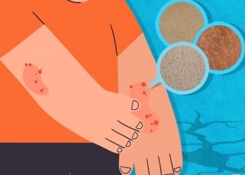 봄 되면 올라오는 닭살·뱀살…치료와 예방법은