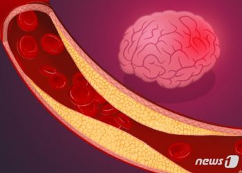 뇌 속 시한폭탄 ‘뇌동맥류’…두통 심하면 바로 병원으로