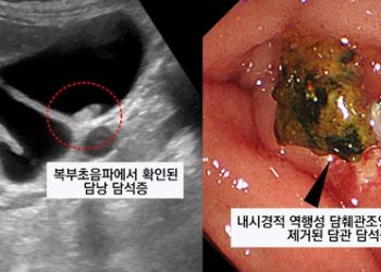 명치 심하게 아프다면 담석증 의심…식습관 개선해야