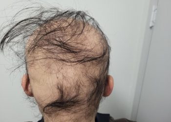 석달새 머리 다 빠진 ‘탈모’ 男 “생식기 털도 한 움큼씩…여친과도 이별” 눈물