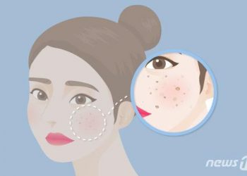 [100세건강] 여름 지나니 얼굴이 거뭇거뭇…이거 기미야, 뭐야?