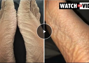 반신욕하다 잠든 여성 끔찍한 발바닥에 충격