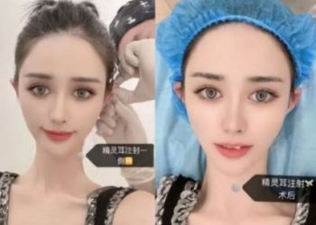 中 여성들, 얼굴 작아 보이려고 뾰족한 ‘엘프 귀’ 성형 열풍