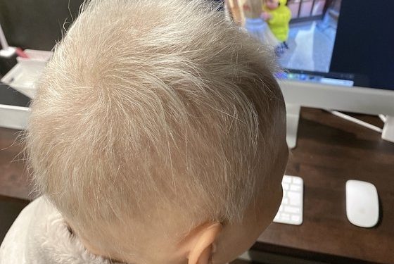 접종 후 ‘민머리’ 됐던 20대女 근황…”흰머리 났다”