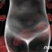 “초기증상 전혀 없다”…’침묵의 암’ 난소암 매년 3000명