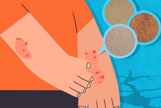 봄 되면 올라오는 닭살·뱀살…치료와 예방법은