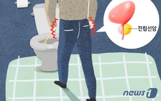 뚱보 노리는 ‘아버지 암’ 전립선암…로봇수술로 효과