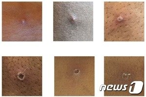 WHO “원숭이두창, 사람간 접촉이 주 감염경로…공기전파는 아직 불분명”