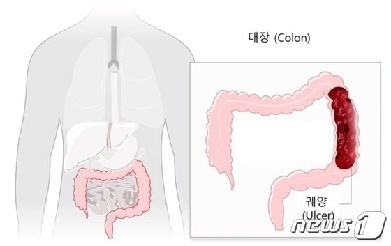 ‘4주 넘게 설사’ 계속되고 혈변…’궤양성 대장염’ 가능성