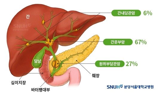 민물고기 회 먹고 황달 걸렸다면…’담관암’ 의심