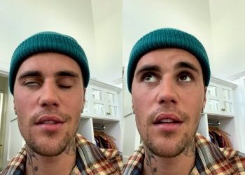 저스틴 비버 앓는 ‘람세이헌트’…비슷한듯 다른 구안와사