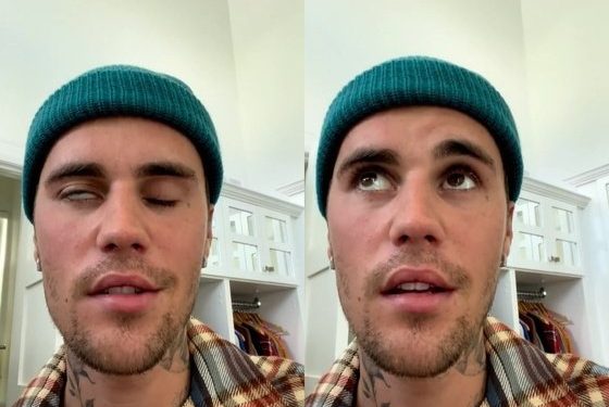 저스틴 비버 앓는 ‘람세이헌트’…비슷한듯 다른 구안와사