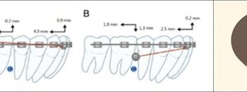 발치하지 않고, 수술도 없이 ‘주걱턱’ 치료 가능해졌다