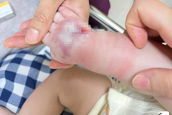 생후 72일 아기 손등 괴사…”링거 테이핑 떼자 살점 뜯겼다”