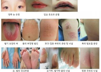 “심혈관계 가족력 있으면 가와사키병 발병 위험 증가”