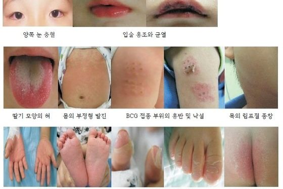 “심혈관계 가족력 있으면 가와사키병 발병 위험 증가”