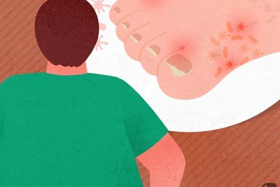 무좀약은 독하다고? 옛날 얘기…”안전한 약으로 처방 중”