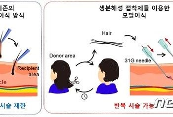 KAIST ‘모발 이식’ 가능 생체친화 의료 접착제 개발