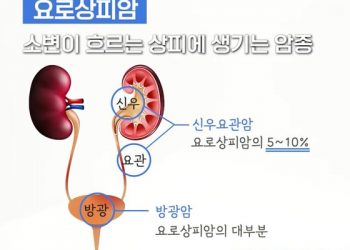 혈뇨에 옆구리 통증…남성에 두 배 많은 ‘신우요관암’
