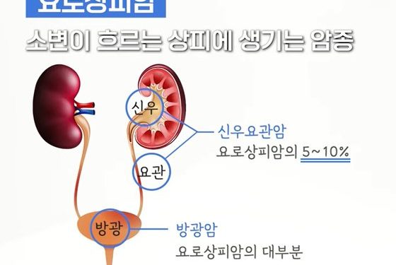 혈뇨에 옆구리 통증…남성에 두 배 많은 ‘신우요관암’