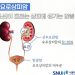 혈뇨에 옆구리 통증…남성에 두 배 많은 ‘신우요관암’
