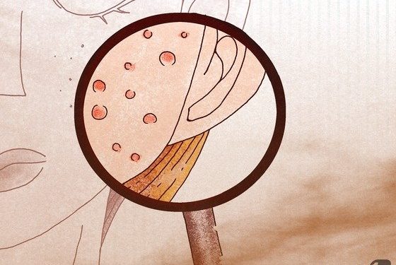 여드름약 먹는다면 임신·헌혈 금물…기형아 출산 우려