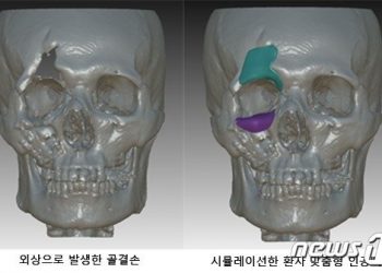 ‘3D 프린터’로 얼굴 뼈도 만드는 시대…”손상부위 이식 성공”