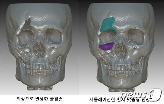 ‘3D 프린터’로 얼굴 뼈도 만드는 시대…”손상부위 이식 성공”