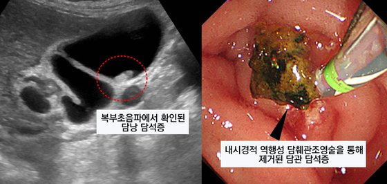 명치 심하게 아프다면 담석증 의심…식습관 개선해야