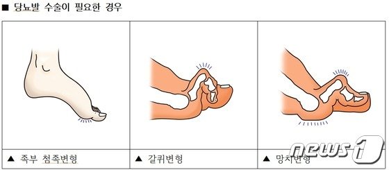 당뇨 환자, 발에 상처 생기지 않도록 늘 관리해야…”방치하다간 큰일”