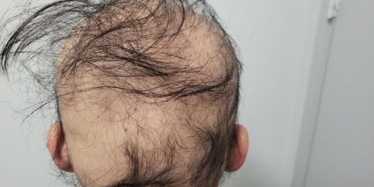 석달새 머리 다 빠진 ‘탈모’ 男 “생식기 털도 한 움큼씩…여친과도 이별” 눈물