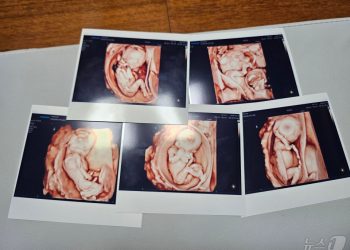 ‘자연 임신’ 다섯 쌍둥이 세상 밖으로…한국내 첫 사례