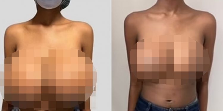 “코로나 백신 맞고 가슴 4배”…한국 웹툰 작가도 겪었다는데, 진짜 부작용?