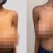 “코로나 백신 맞고 가슴 4배”…한국 웹툰 작가도 겪었다는데, 진짜 부작용?