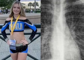 치어리더 활동했던 17세 여학생 ‘폐질환’ 판정…원인은 전자담배 흡연