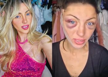 30차례 성형한 ‘인간 바비’ 인플루언서, 변호사 자택서 속옷 차림 숨진 채 발견