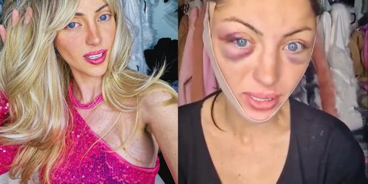 30차례 성형한 ‘인간 바비’ 인플루언서, 변호사 자택서 속옷 차림 숨진 채 발견