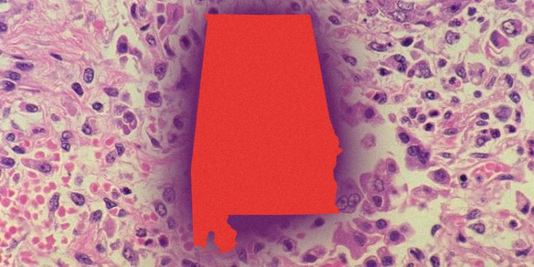 앨라배마 보건당국 “홍역 발생 가능성 대비”…“확진 사례 곧 나올 것”