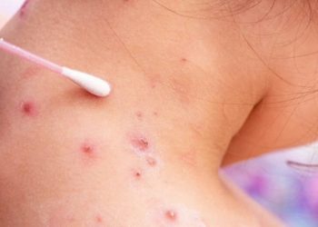 앨라배마 북부서 홍역 노출자 195명 확인…헌츠빌 식당·마트 방문객 주의