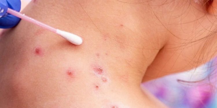 앨라배마 북부서 홍역 노출자 195명 확인…헌츠빌 식당·마트 방문객 주의